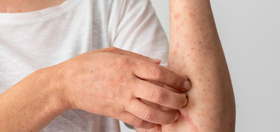 Impetigo